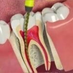 The Ultimate Guide to Root Canal Treatment