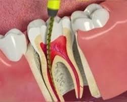 Root Canal Treatment